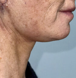 Face/Neck Lift