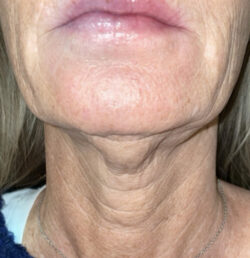 Face/Neck Lift