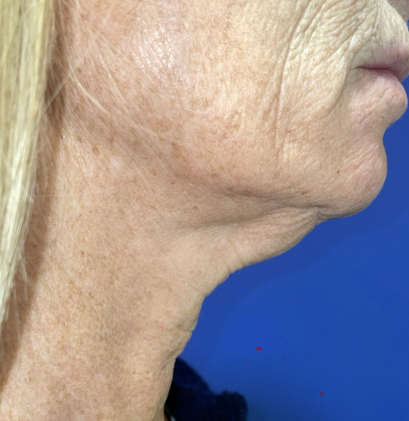 Face/Neck Lift