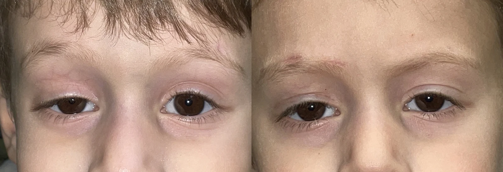 Congenital Ptosis 1 Congenital Ptosis patient