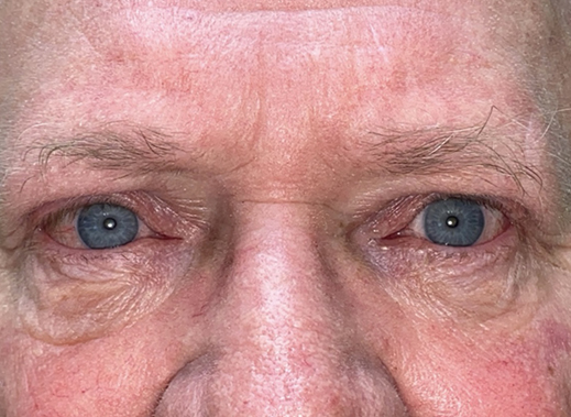 Eyelid Lift (Blepharoplasty/Ptosis Repair)