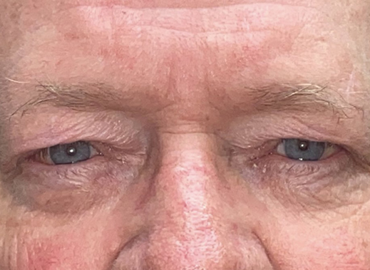 Eyelid Lift (Blepharoplasty/Ptosis Repair)