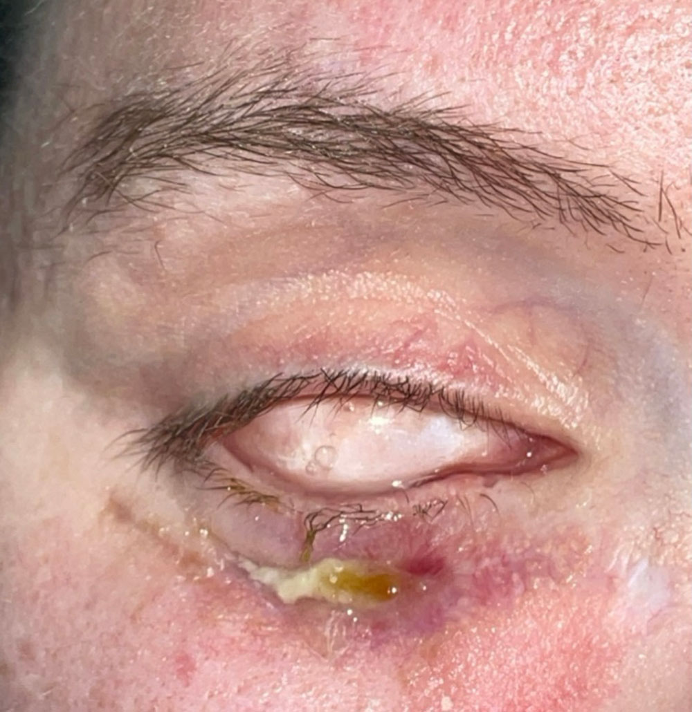 Gun Shot Wounds 1 gun shot wounds patient