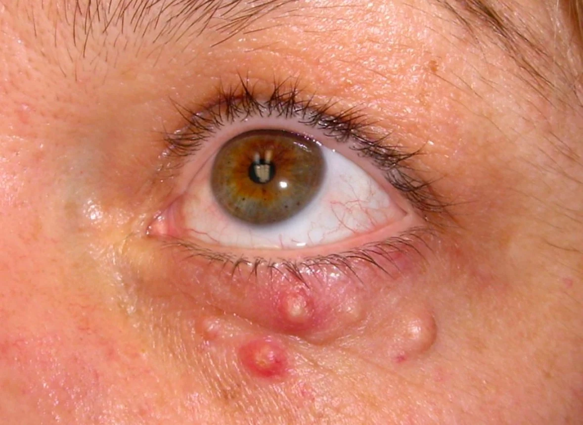 molluscum contagiosum