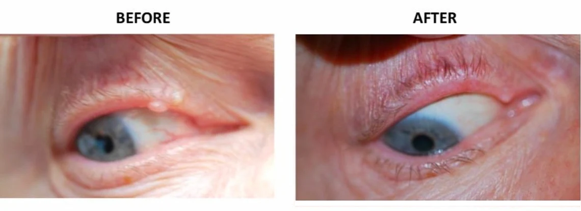 papilloma before and after