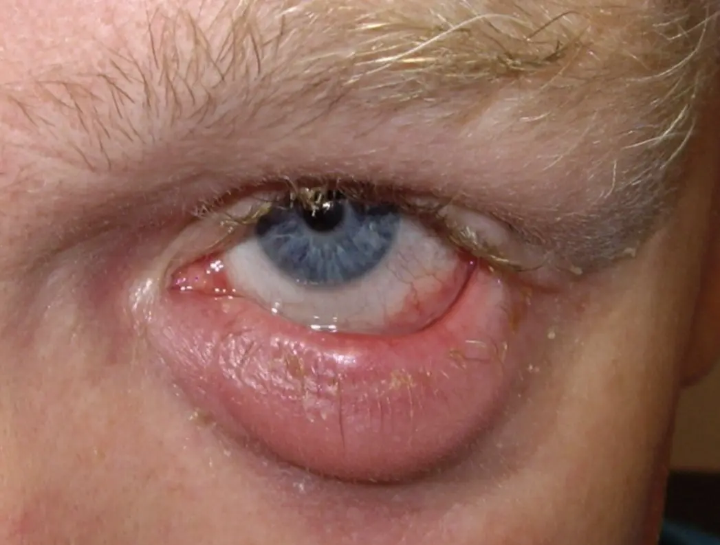 EYE INFLAMMATION img1