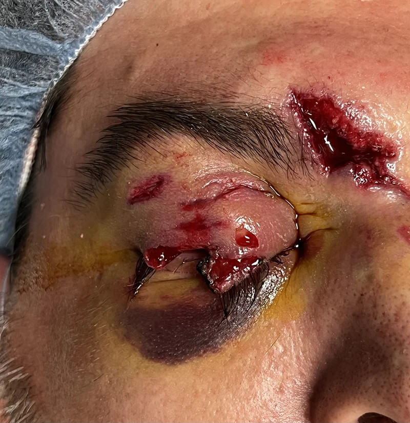 Eyelid Trauma 1 Eyelid avulsion 1