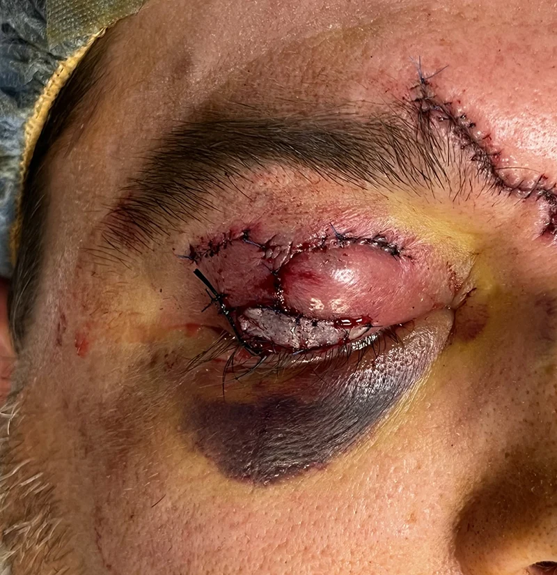 Eyelid Trauma 2 Eyelid avulsion 2