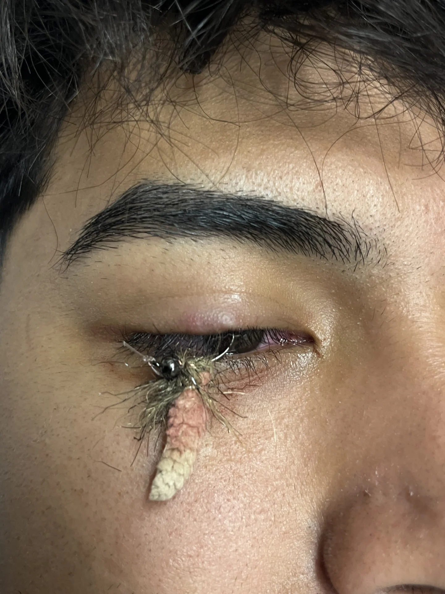Puncture wounds