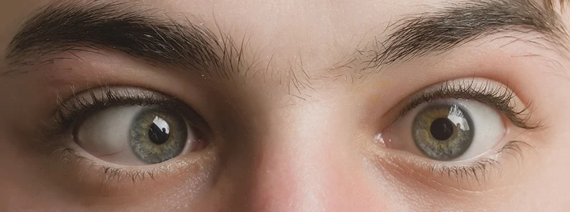 Strabismus