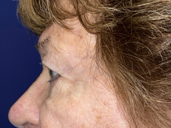 Brow/Forehead Lift