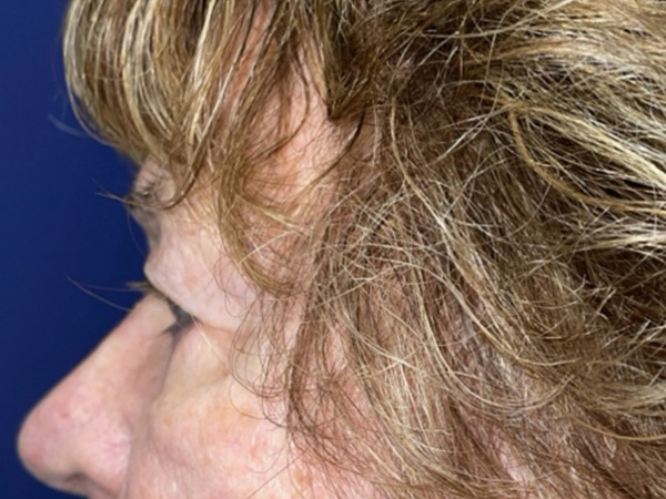 Brow/Forehead Lift