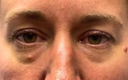Lower Lid Blepharoplasty (lower eyelid eyelift)