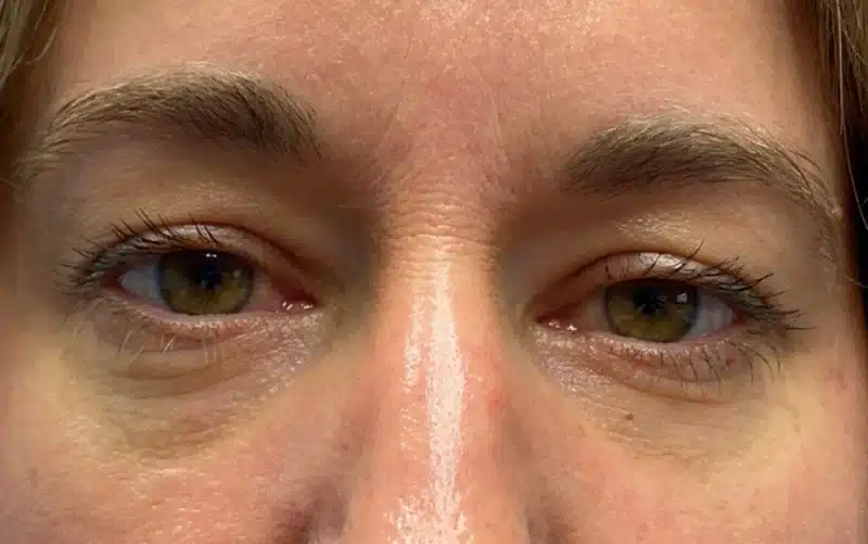 Lower Lid Blepharoplasty (lower eyelid eyelift)