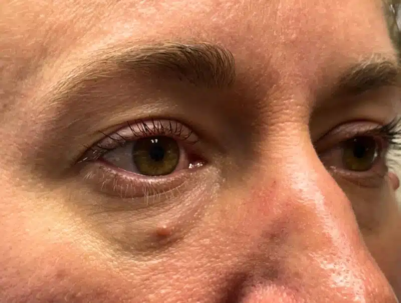Lower Lid Blepharoplasty (lower eyelid eyelift)