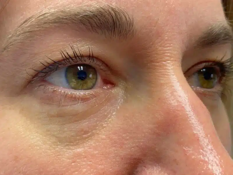 Lower Lid Blepharoplasty (lower eyelid eyelift)