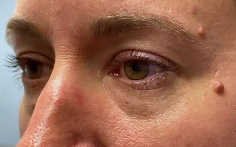 Lower Lid Blepharoplasty (lower eyelid eyelift)