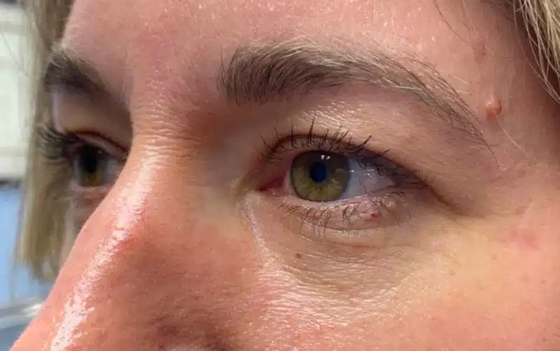 Lower Lid Blepharoplasty (lower eyelid eyelift)