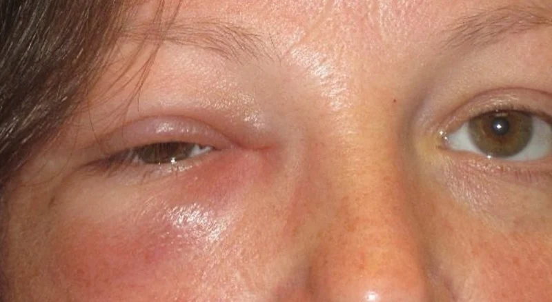 orbital abscess