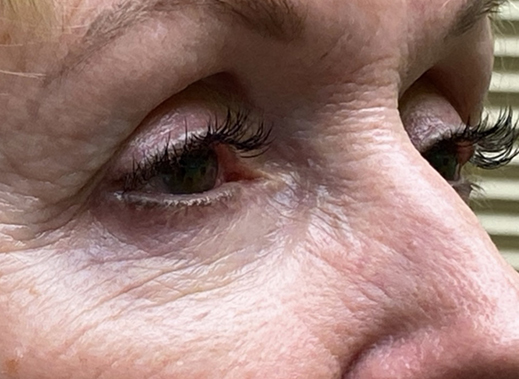 Eyelid Lift (Blepharoplasty/Ptosis Repair)