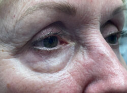 Eyelid Lift (Blepharoplasty/Ptosis Repair)
