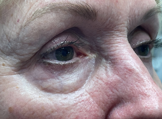 Eyelid Lift (Blepharoplasty/Ptosis Repair)
