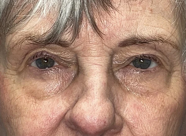 Lower Lid Blepharoplasty (lower eyelid eyelift)