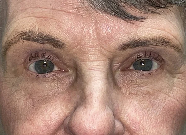 Lower Lid Blepharoplasty (lower eyelid eyelift)