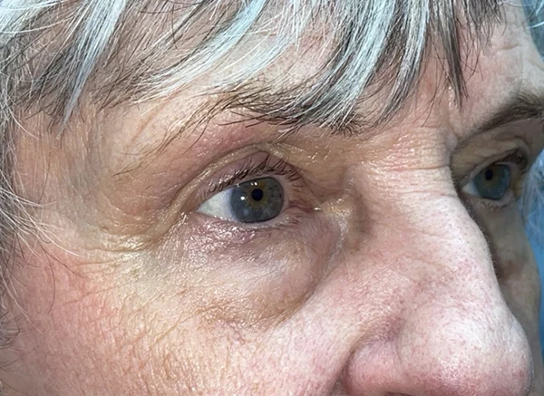 Lower Lid Blepharoplasty (lower eyelid eyelift)