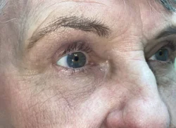 Lower Lid Blepharoplasty (lower eyelid eyelift)