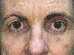 Brow/Forehead Lift