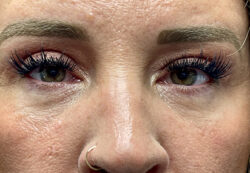 Upper/Lower Lid Blepharoplasty