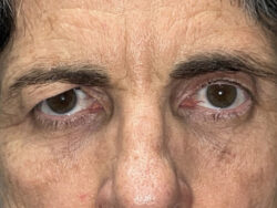 Brow/Forehead Lift