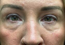 Upper/Lower Lid Blepharoplasty