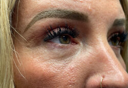 Upper/Lower Lid Blepharoplasty