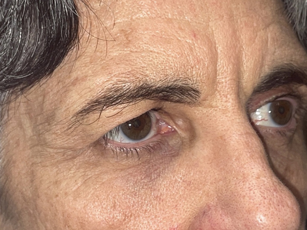 Brow/Forehead Lift
