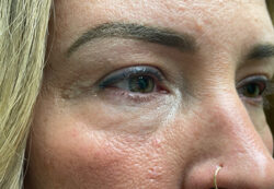 Upper/Lower Lid Blepharoplasty
