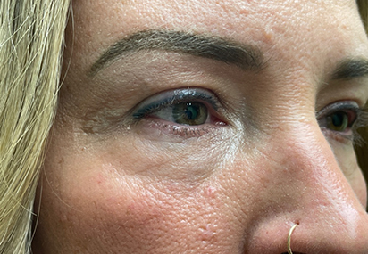 Upper/Lower Lid Blepharoplasty