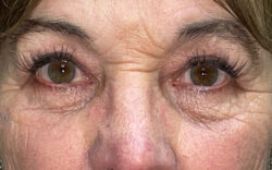 Eyelid Lift (Blepharoplasty/Ptosis Repair)