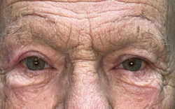 Eyelid Lift (Blepharoplasty/Ptosis Repair)