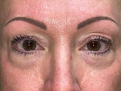 Upper Lid Blepharoplasty (upper eyelid lift)