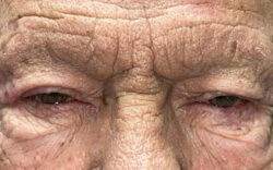 Eyelid Lift (Blepharoplasty/Ptosis Repair)