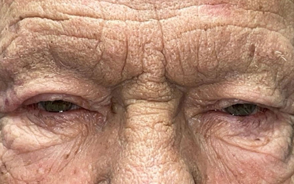 Eyelid Lift (Blepharoplasty/Ptosis Repair)