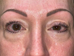 Upper Lid Blepharoplasty (upper eyelid lift)