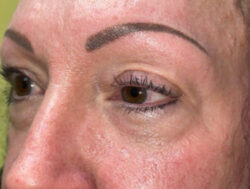 Upper Lid Blepharoplasty (upper eyelid lift)