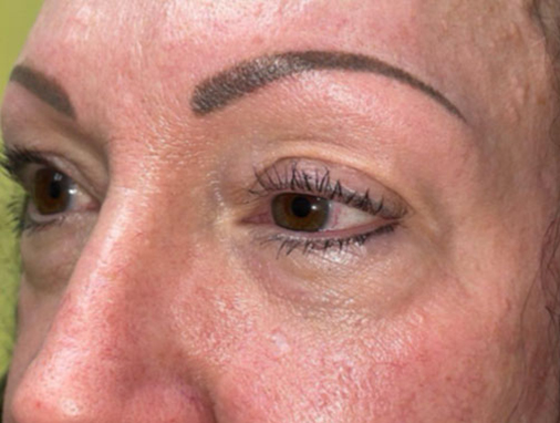 Upper Lid Blepharoplasty (upper eyelid lift)