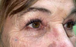Eyelid Lift (Blepharoplasty/Ptosis Repair)