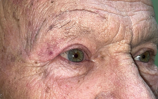 Eyelid Lift (Blepharoplasty/Ptosis Repair)