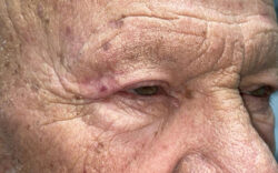 Eyelid Lift (Blepharoplasty/Ptosis Repair)