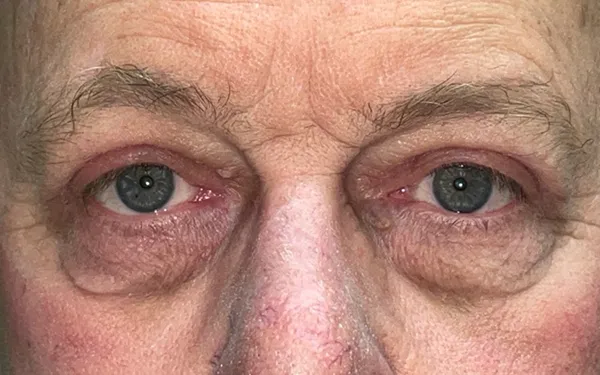 Eyelid Lift (Blepharoplasty/Ptosis Repair)